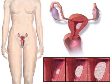 Cáncer de endometrio