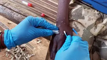 Heridas viruela del mono o mpox