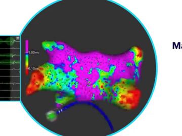 Pionero tratamiento de la fibrilación auricular persistente