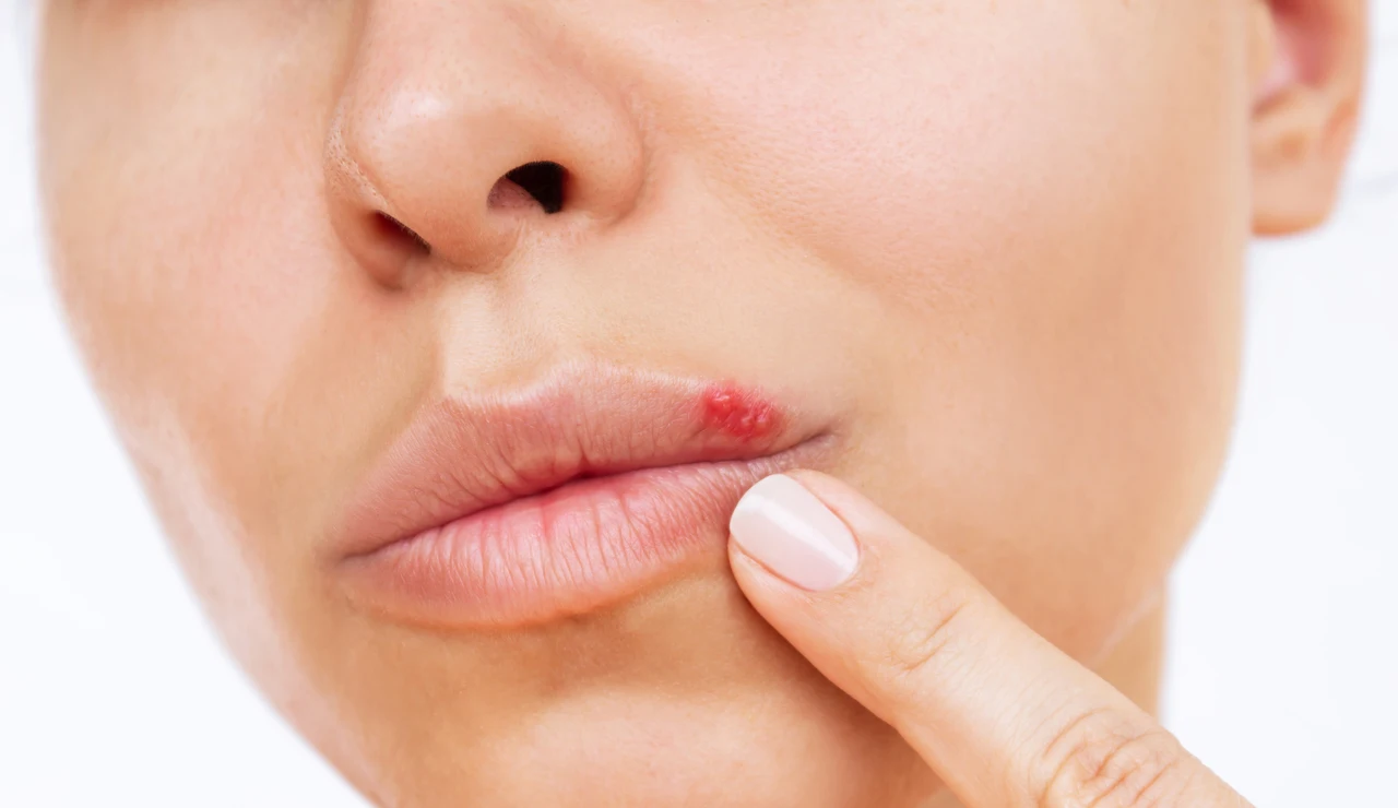 Una mujer con herpes labial